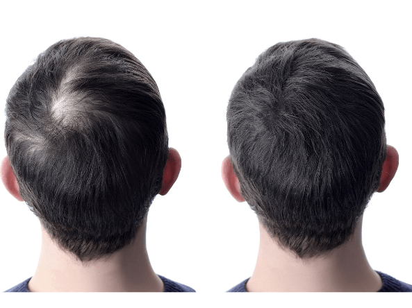 kale plekken hoofd verbergen