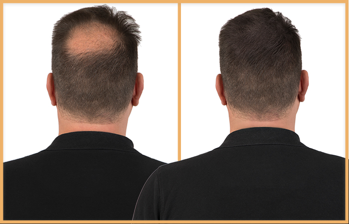 haarpoeder man effect